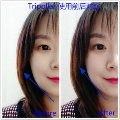 雅萌、GEVILAN歌嵐、Tripollar、NEWA美容儀到底選哪個？先評測一下再說