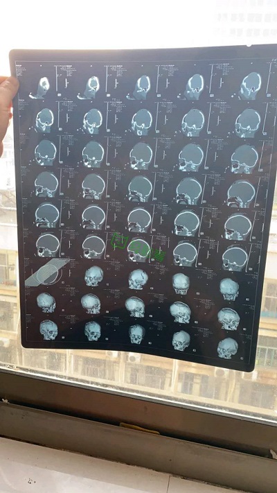 湖南婁底6歲女童遭男子揮鋤頭砸傷，輕松籌上已籌集百萬(wàn)愛(ài)心善款