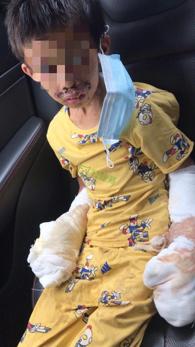 生命接力！輕松籌上愛心匯聚，幫助被生父燒傷的可憐男童重獲新生